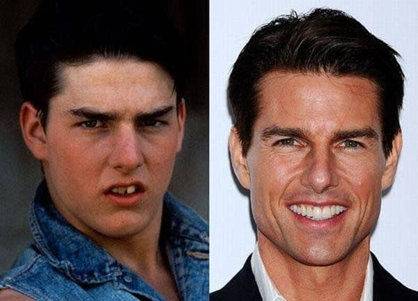 tom cruise old photos teeth