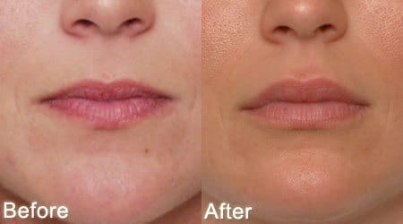 Minimize Lip Lines, According To Experts