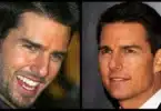 Tom Cruise Plastic Surgery